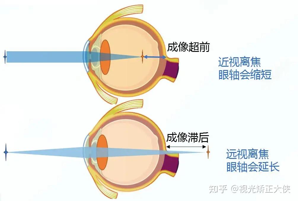 近视手术全网最全科普！提前做好功课！摘镜效果不打折扣！（看完就赚到了）